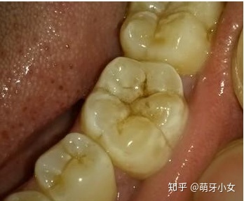 牙神经外露怎么治疗