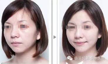 玻尿酸丰苹果肌效果