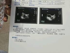 怀孕3个月孕囊多大