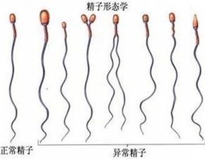 畸形精子症怎么治疗