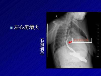 左心脏增大是怎么回事