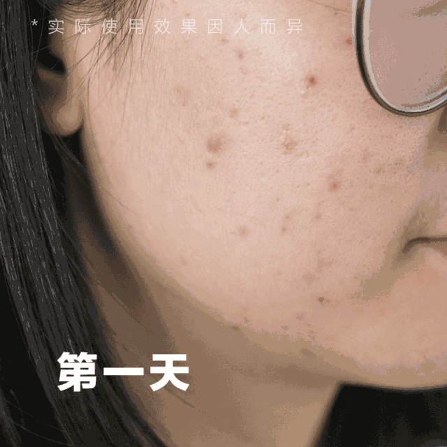脸上痘印怎么消
