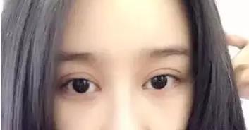 双眼皮割深了