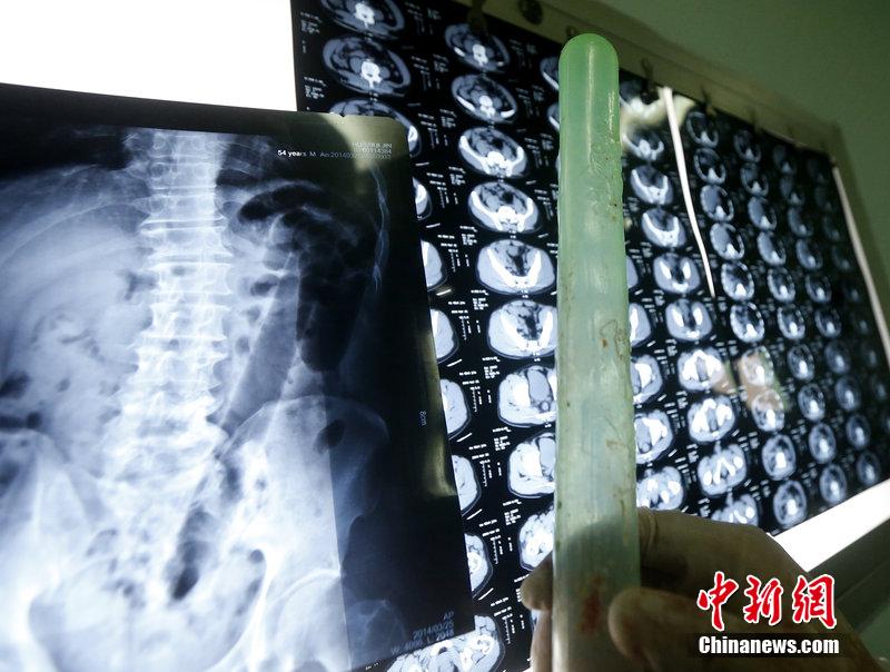 肛门坠胀疼痛是怎么回事