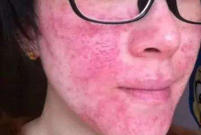 激素脸爆痘痘怎么消炎