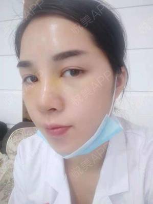 隆鼻7天后拆线疼不疼