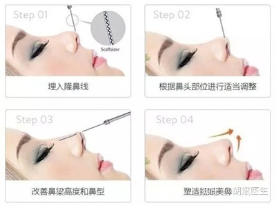 线雕隆鼻一包多少根线
