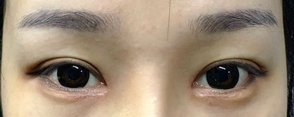 老贴双眼皮贴会怎么样