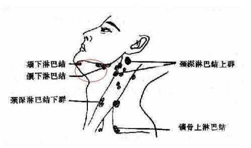 脖子两侧淋巴疼是怎么回事