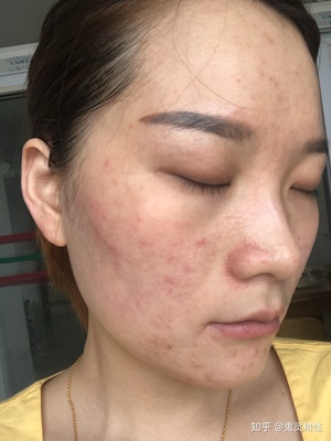 两个星期痘痘好不了