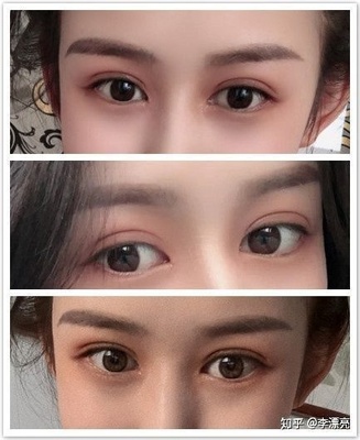 双眼皮如何修复
