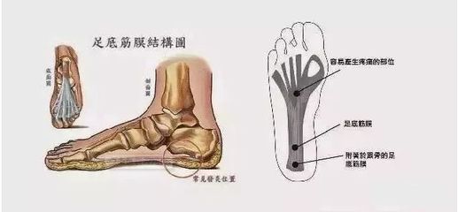 足底筋膜炎怎么治疗