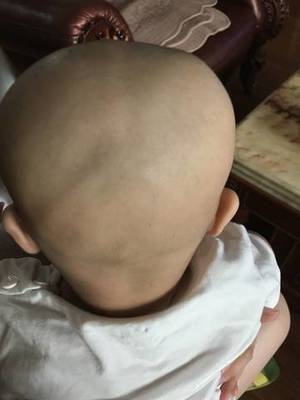 宝宝左侧头骨凸起图片