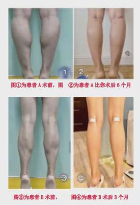 瘦腿哪里整容