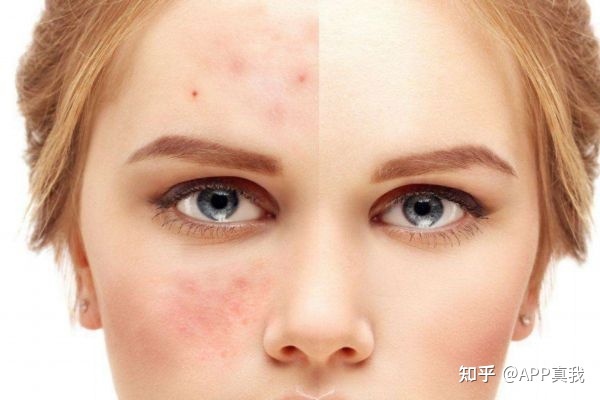 痘痘有周期吗