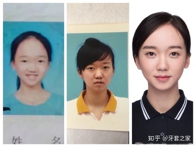 脸型不正左右脸不对称