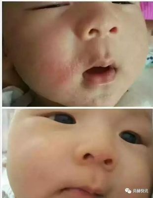满月宝宝起湿疹怎么办