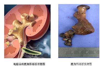 宝宝肾结石有什么症状