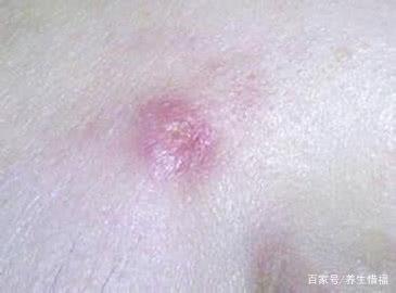 屁股上长疖子怎么治疗
