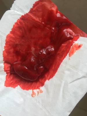 月经期间大块血块是怎么回事