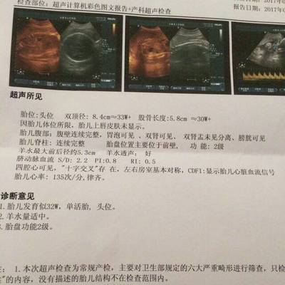 胎儿头偏大是什么原因