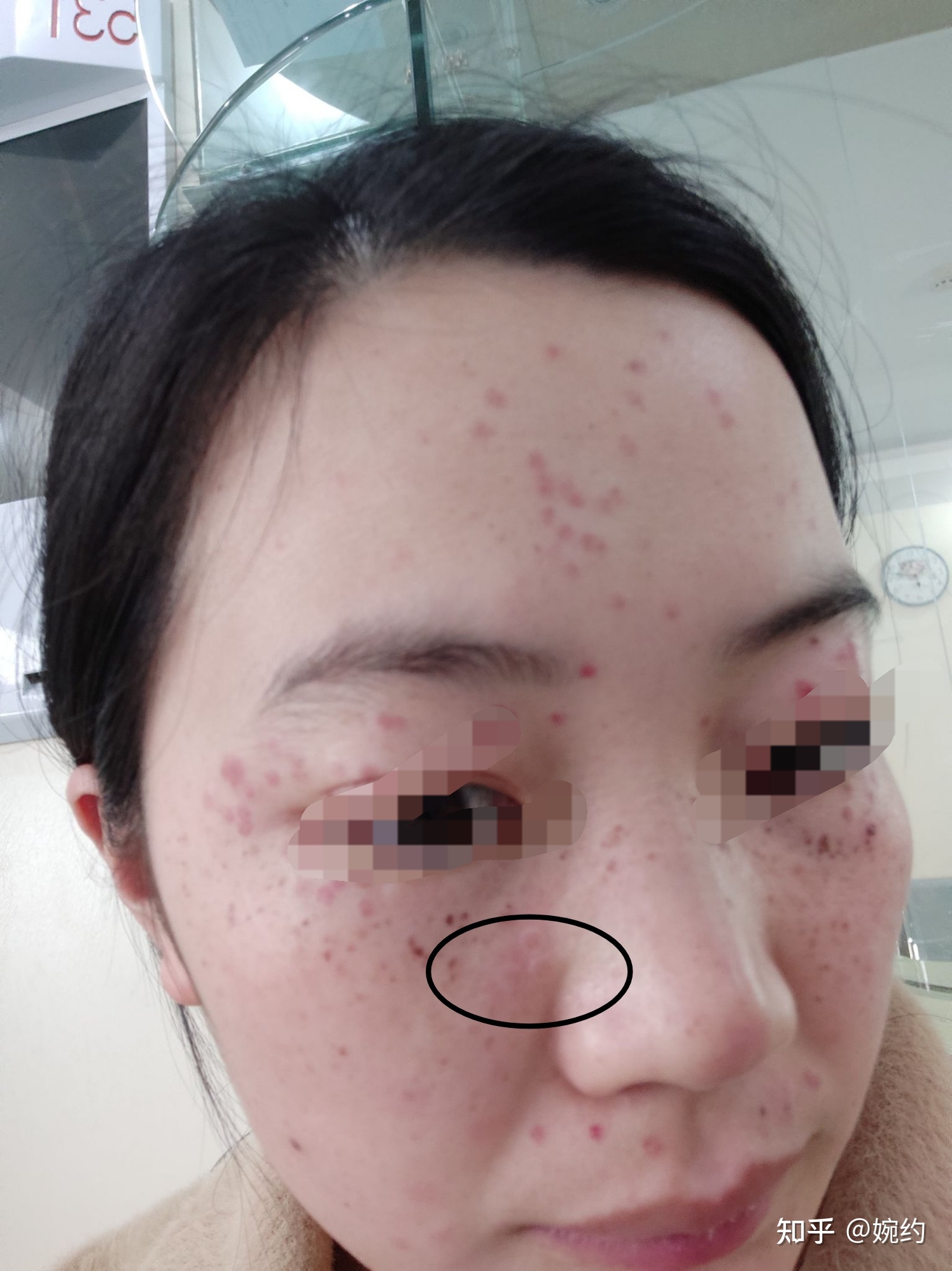 激光祛斑还有斑点
