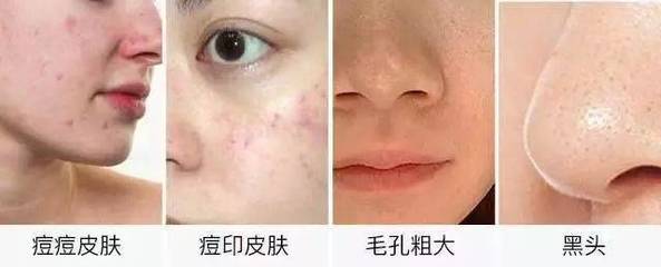 痘痘恢复后的毛孔粗大