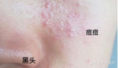 长痘痘去看皮肤科
