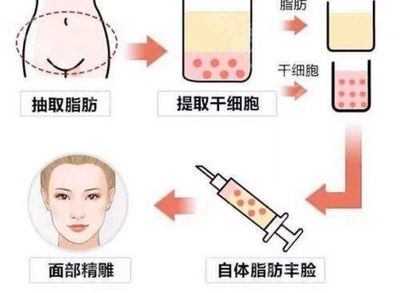 脂肪填充还是玻尿酸好