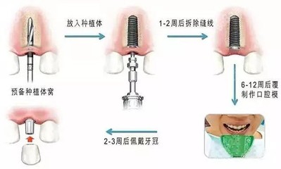 种牙的原理