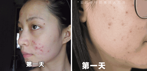 痘痘严重到快烂脸了