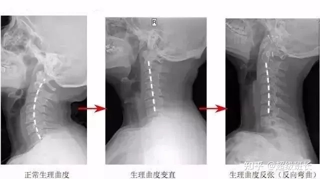 颈椎弯曲怎么治疗