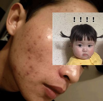 脸上痘痘多还出油