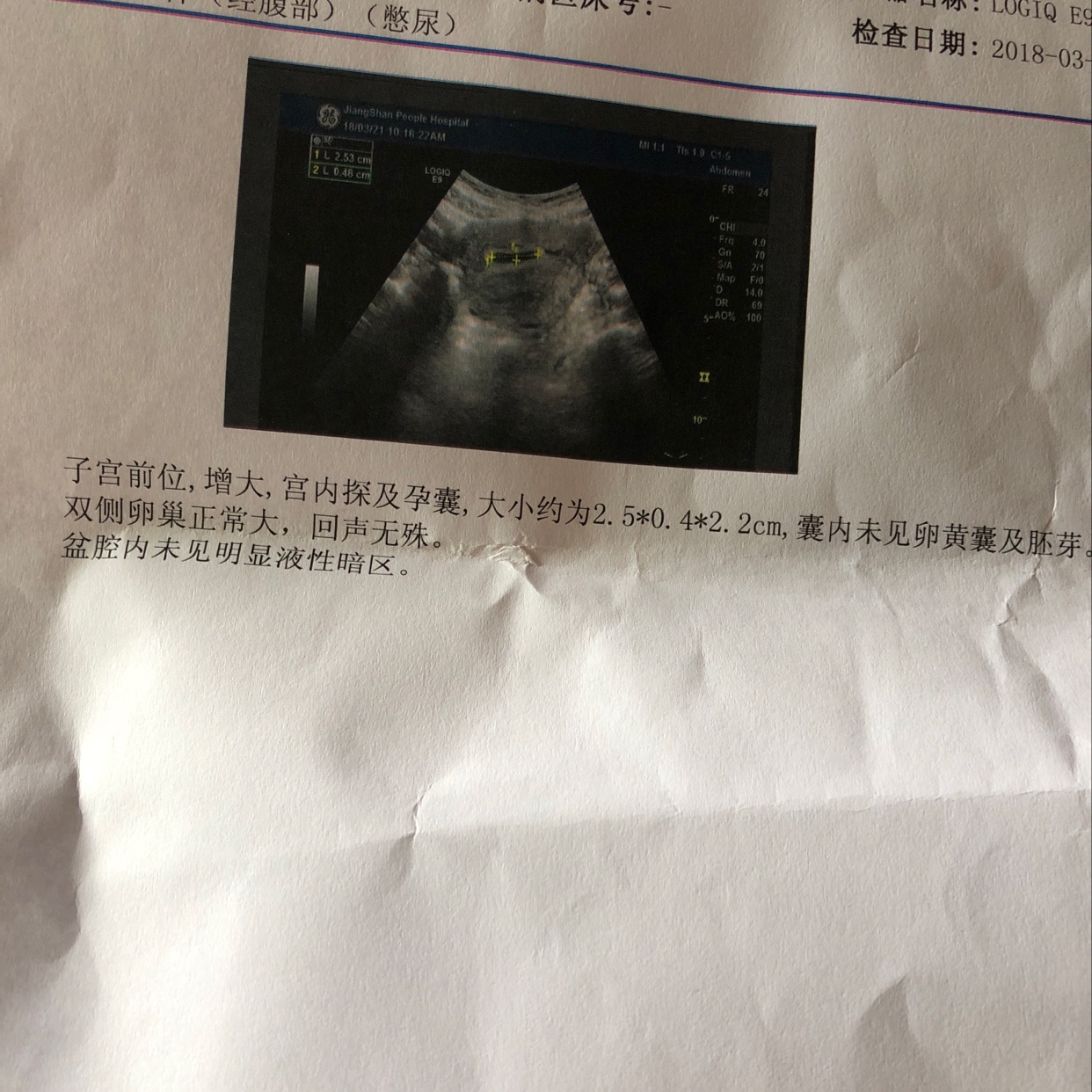 孕囊里没有胚芽是怎么回事
