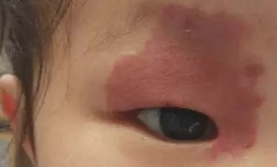 新生儿长痣
