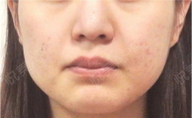 脸上长痘痘用肤大夫