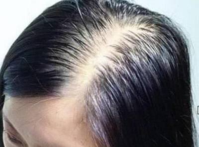 头上长痘痘是什么原因还掉头发