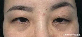 眼部提肌无力怎么解决