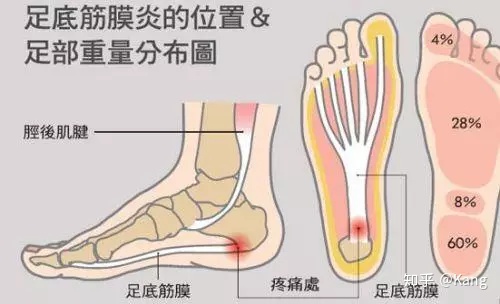 足底筋膜炎怎么治疗能除根
