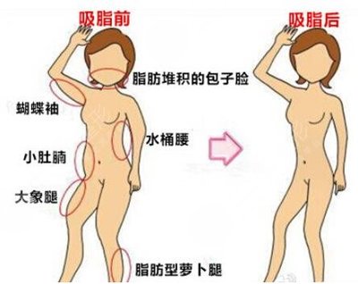 抽脂后几天能洗澡