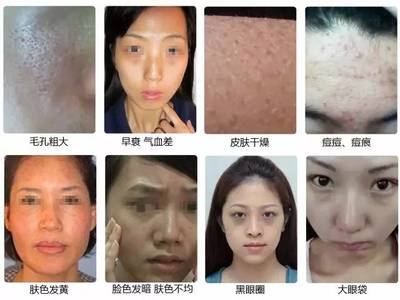痘痘恢复后的毛孔粗大