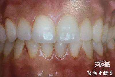 牙周炎早期怎么治疗