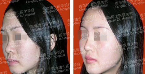 隆鼻效果怎么样