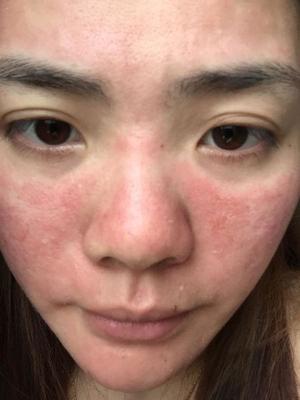 脸颊两侧毛孔越来越大