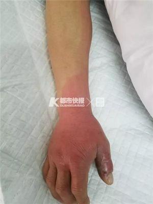 上肢肿胀是怎么回事