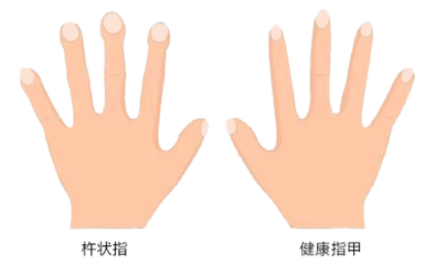 手抖手麻是怎么回事
