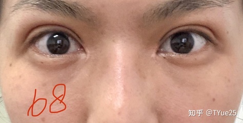 割双眼皮变窄