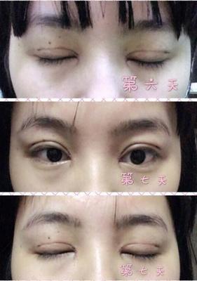 割了双眼皮多久可以碰水