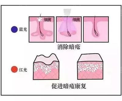 蓝光祛痘原理