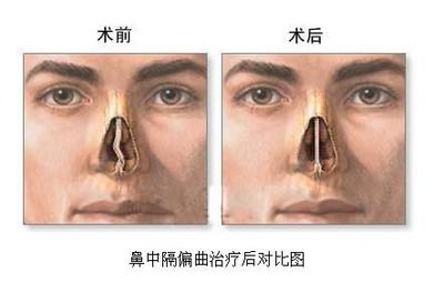 鼻中隔偏曲怎么治疗